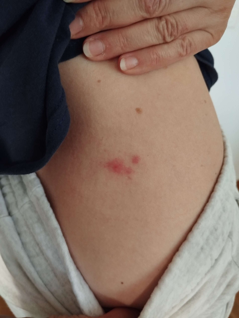 Auf der Haut in Liesberg zeigt sich eine rote Stichstelle, die als moegliches Anzeichen fuer Bettwanzen gilt und den Einsatz eines Kammerjaegers sinnvoll macht.