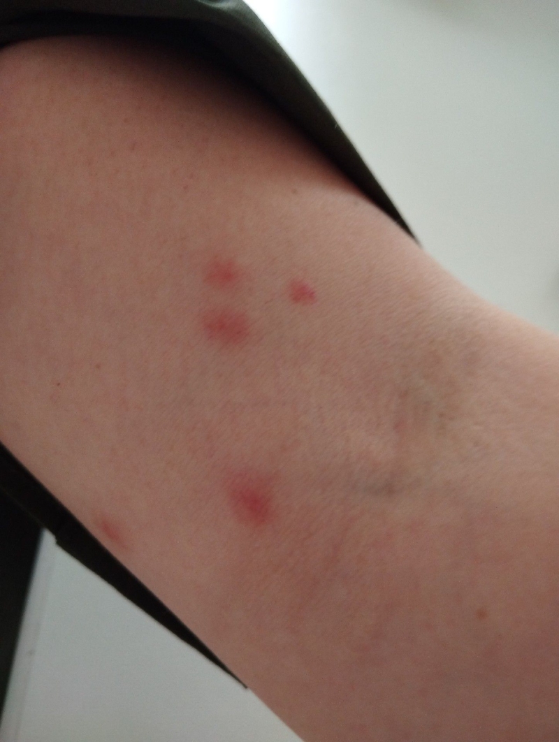 Auf der Haut einer Person in Ruemlingen zeigen rote Stichstellen einen moeglichen Befall durch Bettwanzen, was einen Kammerjaeger auf die betroffene Situation aufmerksam macht.